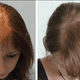 Illustration for article titled Hair Transplant For Women